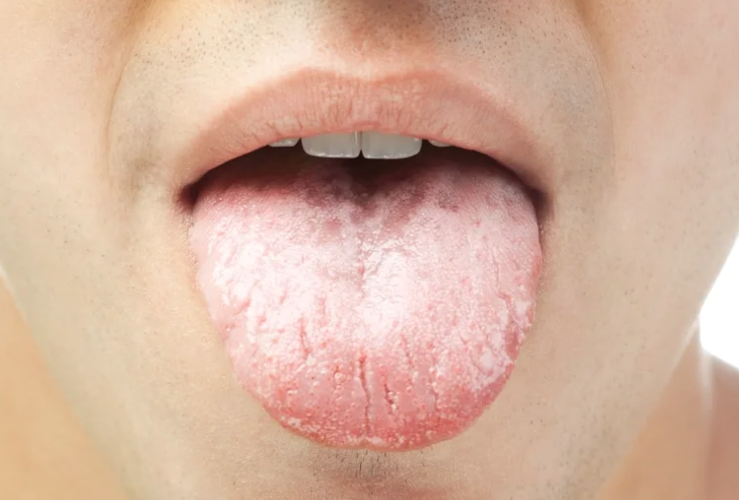 一堆人做錯！專家警告「舌苔用刮的」恐致癌　醫曝「正確清潔方式」