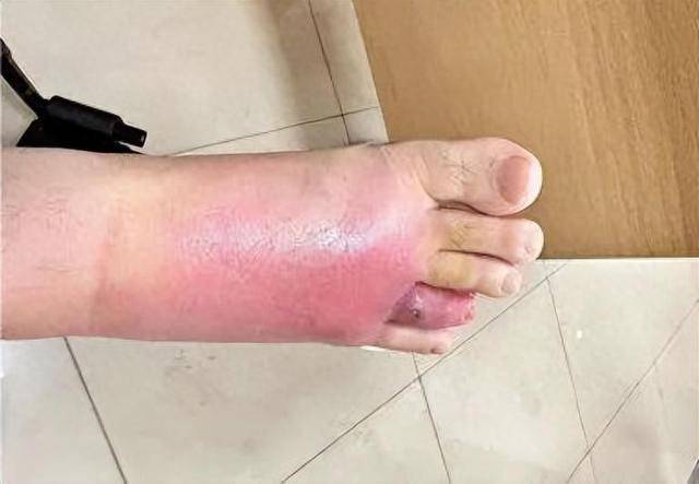 在沙發上光腳睡了一覺，男子腳掌「腫成豬腳」差點截肢！