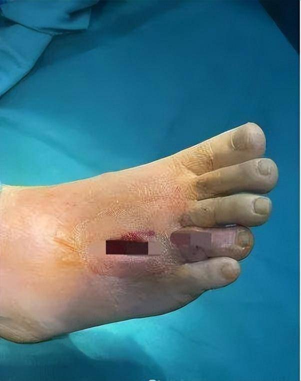 在沙發上光腳睡了一覺，男子腳掌「腫成豬腳」差點截肢！