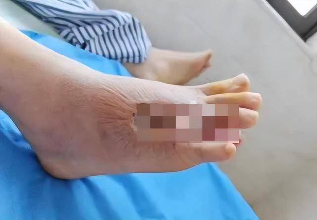 在沙發上光腳睡了一覺，男子腳掌「腫成豬腳」差點截肢！