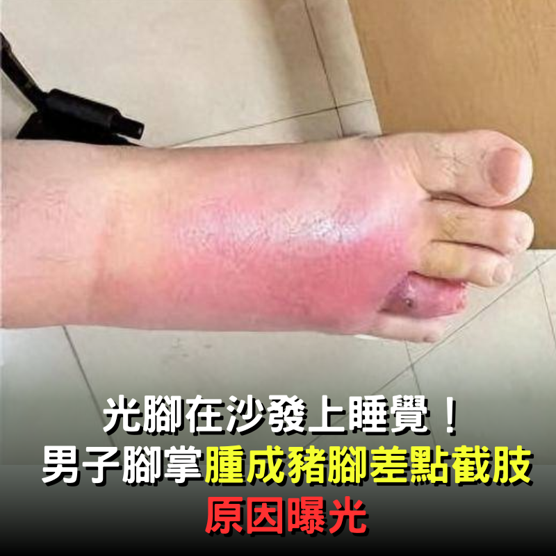 在沙發上光腳睡了一覺，男子腳掌「腫成豬腳」差點截肢！