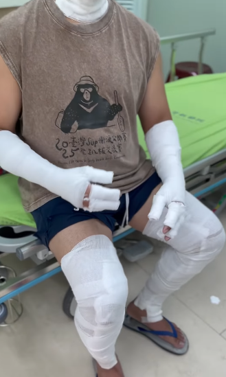 老公才氣爆送醫！47歲大咖歌后「突PO血流不止照」　驚見「整隻纏滿繃帶」粉絲全嚇壞