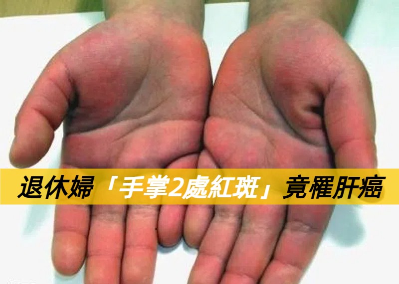 女兒細心觀察救母一命！退休婦手掌驚現紅斑 及早發現肝癌成功治療