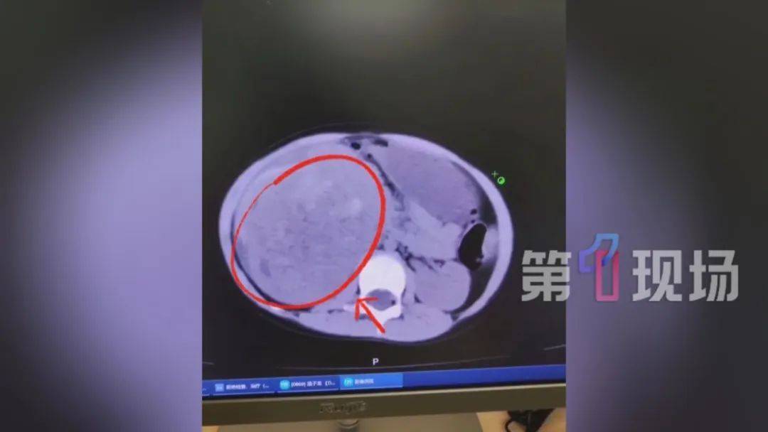 幼稚園玩耍被踩腰！5歲女童「腎臟破裂積血」緊急搶救　醫生嚇壞「已經變形了」現況曝光