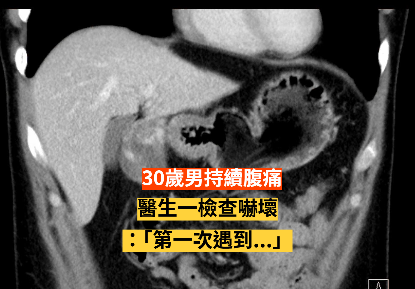 30歲男持續腹痛！一查發現「25公分巨大肝腫瘤」醫生都嚇壞：第一次遇到...