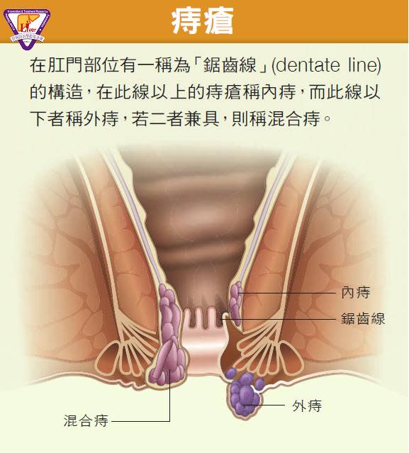 患者突問「痔瘡會遺傳嗎」！醫生揭秘「其實人人都有」：3關鍵很多人中