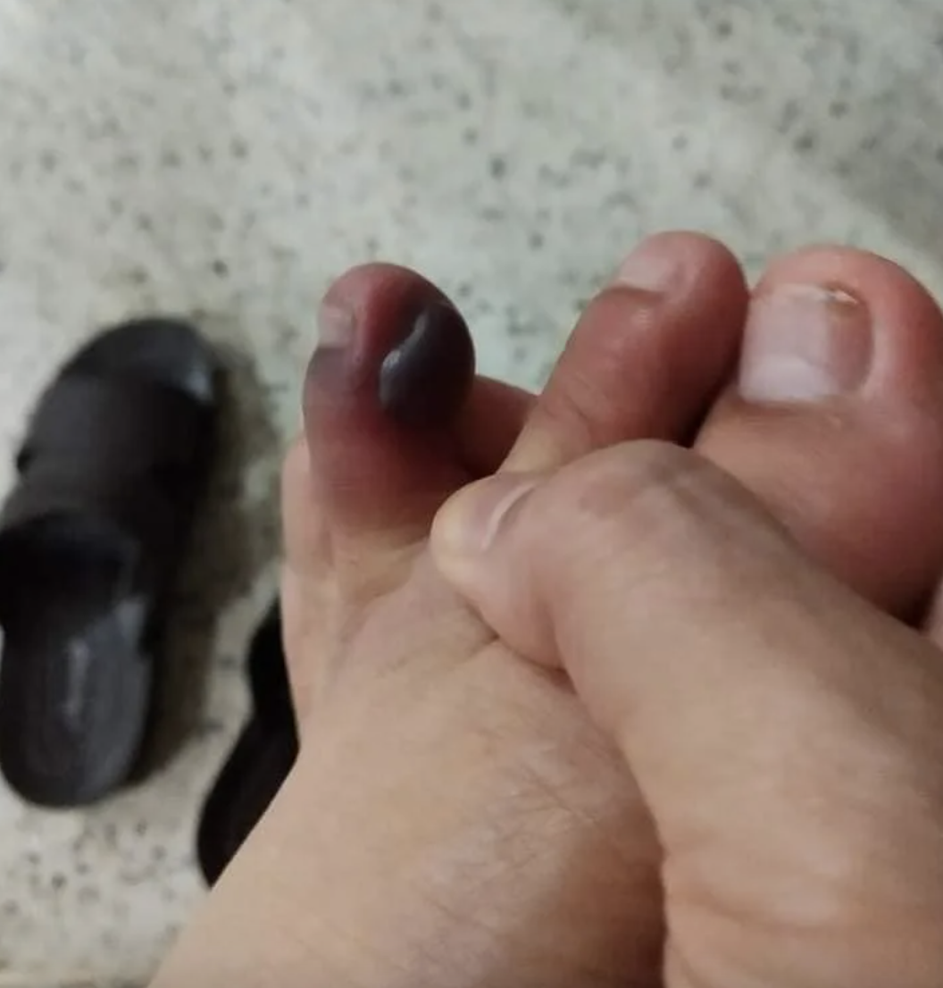 穿鞋前沒檢查！男脫鞋竟發現「腳指頭腫成可麗露」　元兇現身醫示警：嚴重恐皮膚壞死