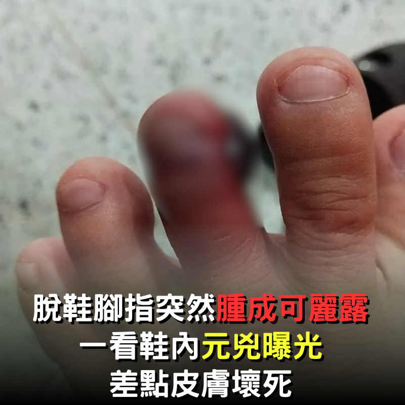 穿鞋前沒檢查！男脫鞋竟發現「腳指頭腫成可麗露」　元兇現身醫示警：嚴重恐皮膚壞死