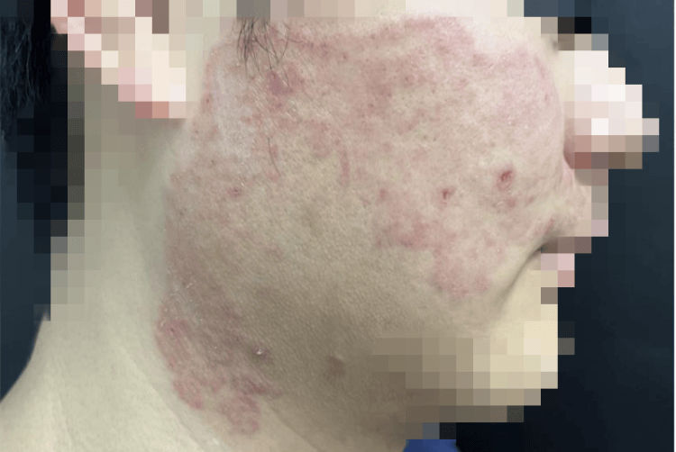 醫生示警「一人感染可傳染全家」！27歲男子「臉部紅腫一片」慘不忍睹：只因做錯一事惹病