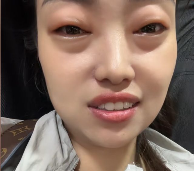 這水果正值旺季！女子「2顆下肚」竟出事：眼睛腫大如蛙　醫生示警「少量就能致命」別大意