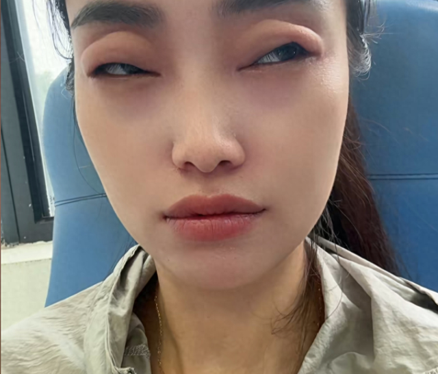 這水果正值旺季！女子「2顆下肚」竟出事：眼睛腫大如蛙　醫生示警「少量就能致命」別大意