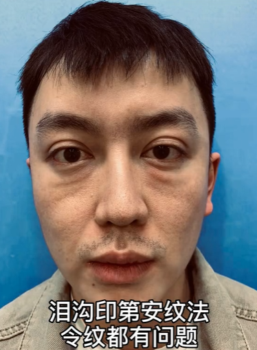 原本是大帥哥！人氣網帥「整形失敗毀容」彷彿老20歲　鏡頭前崩潰痛哭：「能別整就別整了...」