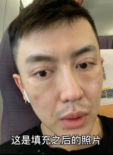 原本是大帥哥！人氣網帥「整形失敗毀容」彷彿老20歲　鏡頭前崩潰痛哭：「能別整就別整了...」