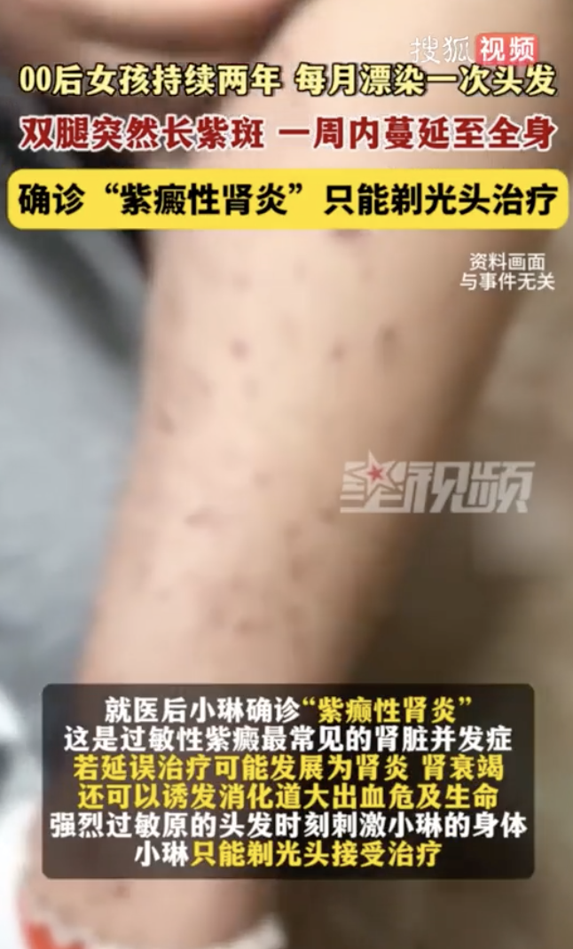 每個月都染髮！20歲女「全身長紫班」尿變咖啡色　醫生「緊急做一事」：成功保命