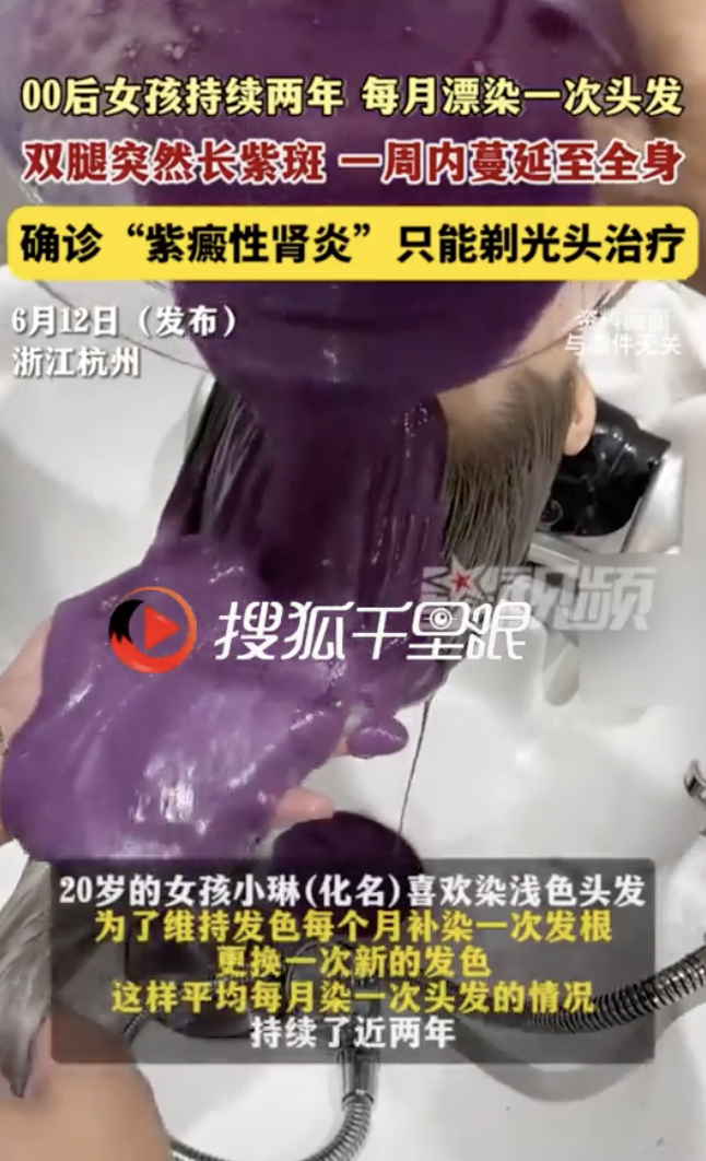 每個月都染髮！20歲女「全身長紫班」尿變咖啡色　醫生「緊急做一事」：成功保命