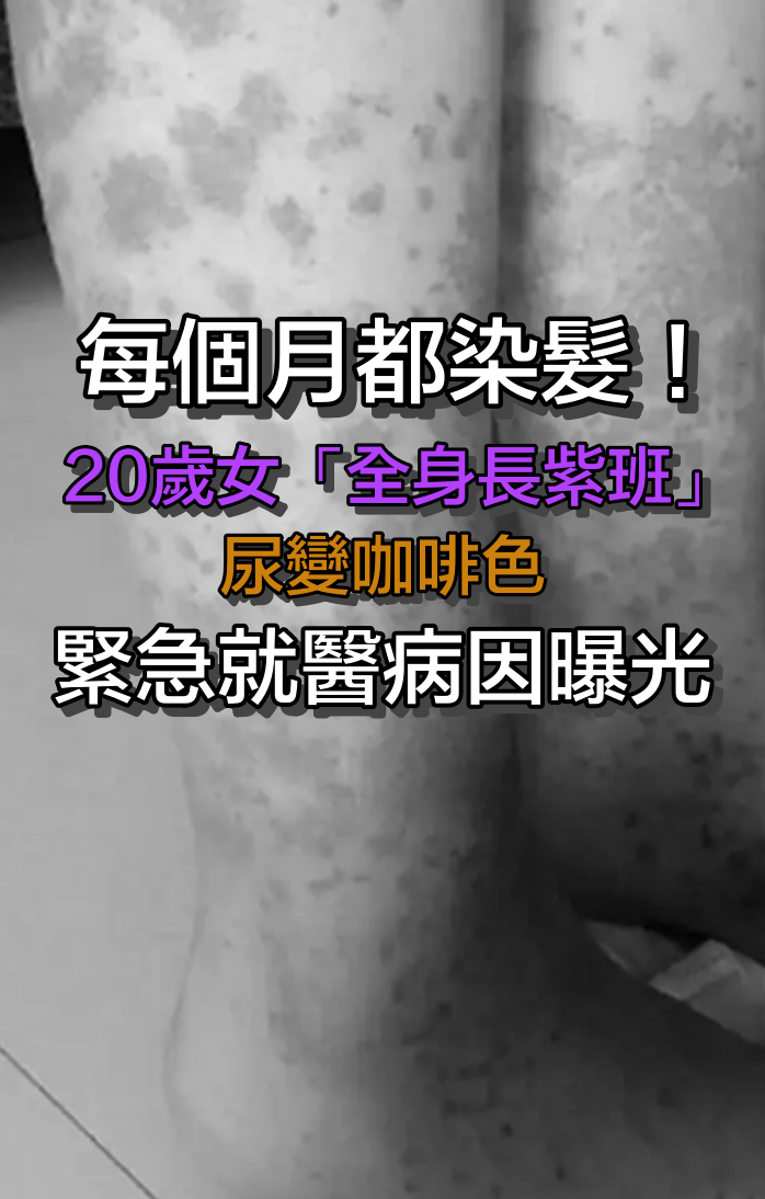 每個月都染髮！20歲女「全身長紫班」尿變咖啡色　醫生「緊急做一事」：成功保命