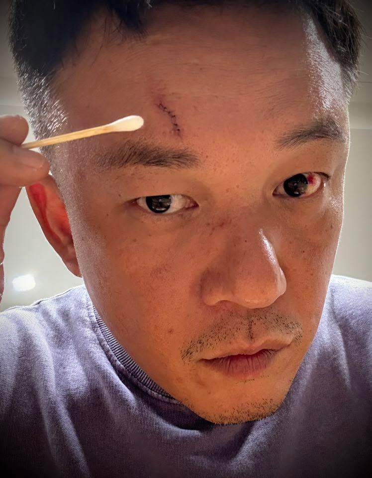 驚傳滿身是血送醫！45歲男星「拍戲出意外」畫面曝光　急喊「沒有怪任何人」公開病況