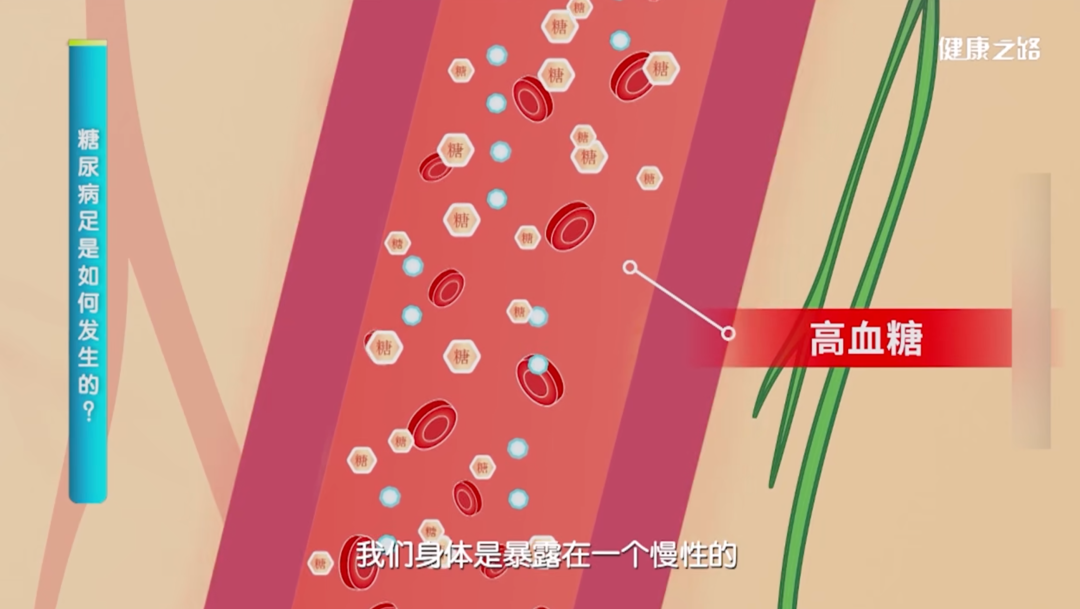 血糖高了「看腳」就知道！如果雙腳「出現5變化」恐患糖尿病