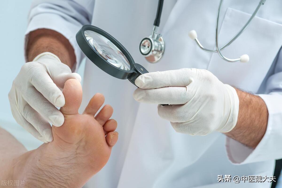 血糖高了「看腳」就知道！如果雙腳「出現5變化」恐患糖尿病