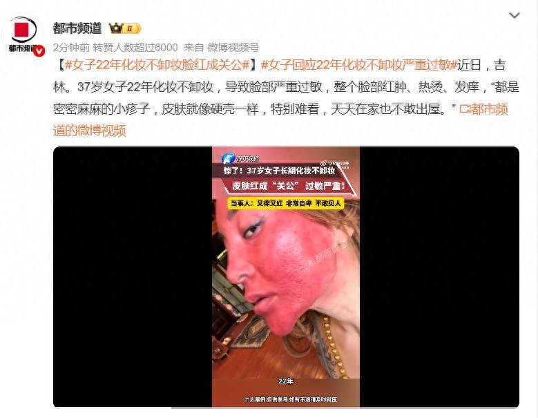 化妝22年從不卸妝！女子「臉部大過敏」腫成關公