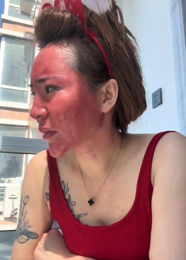 化妝22年從不卸妝！女子「臉部大過敏」腫成關公