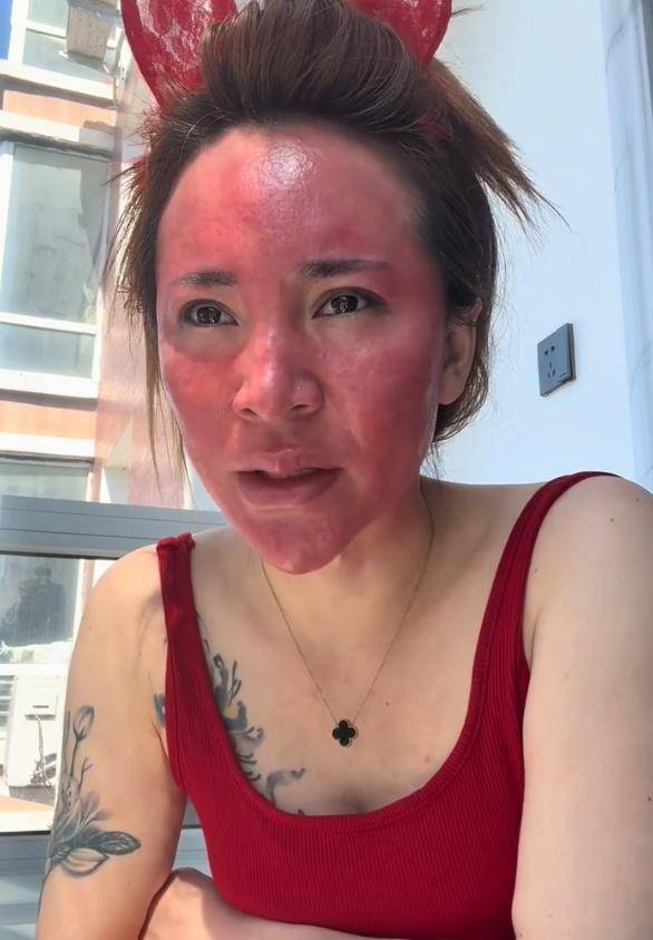 化妝22年從不卸妝！女子「臉部大過敏」腫成關公