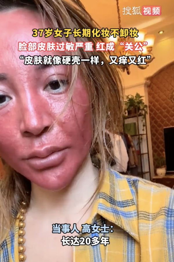 化妝22年從不卸妝！女子「臉部大過敏」腫成關公
