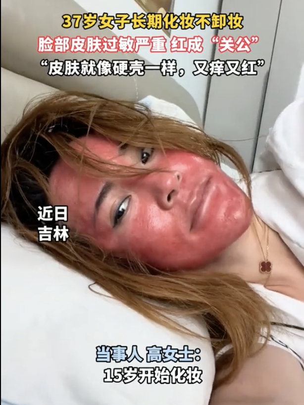 化妝22年從不卸妝！女子「臉部大過敏」腫成關公