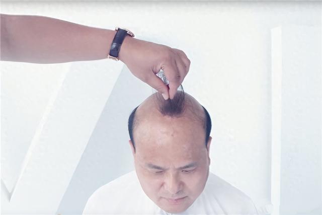 掉髮人的神器！只要吃對「2種常見維生素」擺脫中年危機：方法給你了別錯過