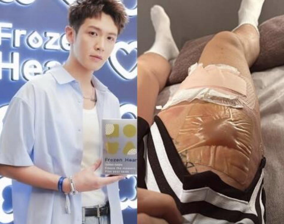34歲影帝剛過生日就出事！躺床「大腿浮起兩腫包」包紮病況曝光