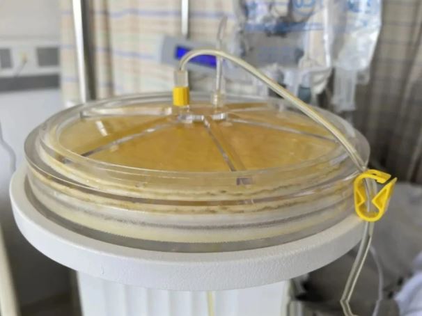 夏天是腦梗高發期！67歲阿姨「只覺頭暈難受」竟是腦中風　醫提醒：4件事「必須提早做」
