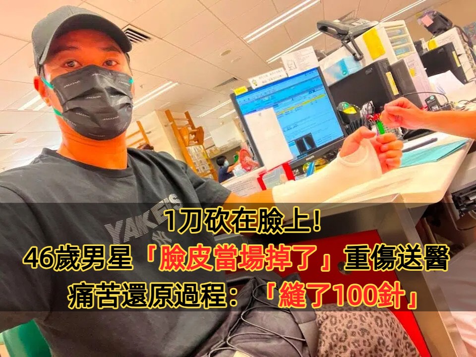 1刀砍在臉上！46歲男星「臉皮當場掉了」重傷送醫　痛苦還原過程：「縫了100針」