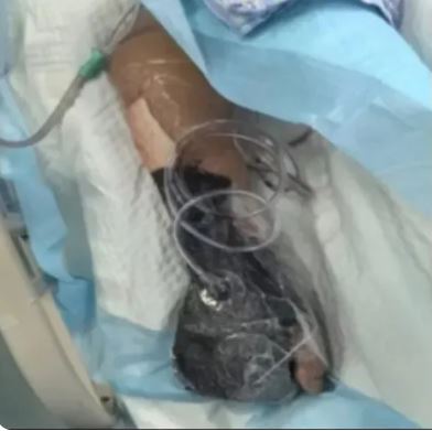傷口才米粒大！老人不在意「皮膚變黑流膿」　不到24小時休克「截肢不治」