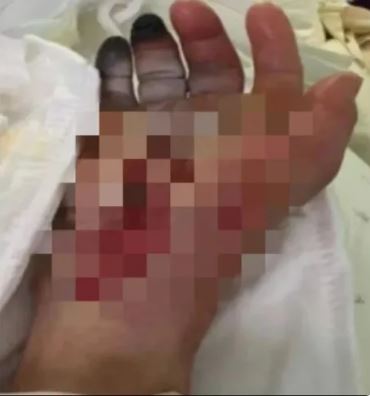 傷口才米粒大！老人不在意「皮膚變黑流膿」　不到24小時休克「截肢不治」