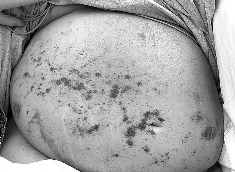 接受腎臟移植！61歲患者「突休克送醫」緊急插管　一照「體內全是蟲」真相曝光