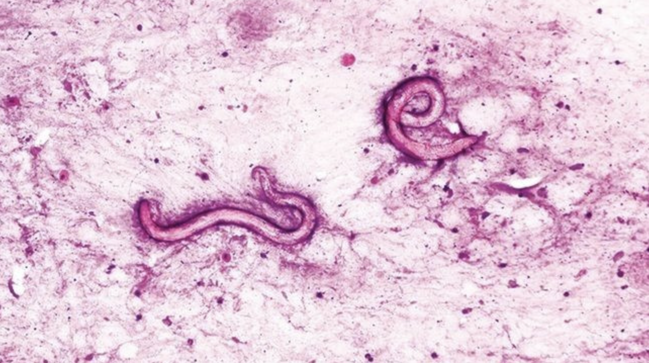 接受腎臟移植！61歲患者「突休克送醫」緊急插管　一照「體內全是蟲」真相曝光