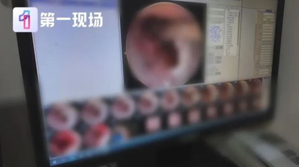 「脖子凸一塊」疼痛難耐！他急入院開刀「驚見7顆黑黑的」　醫傻眼喊「竟藏了20年」...