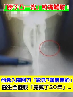 「脖子凸一塊」疼痛難耐！他急入院開刀「驚見7顆黑黑的」　醫傻眼喊「竟藏了20年」...