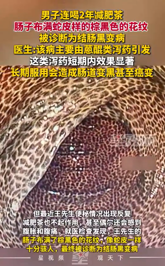很多人中招！66歲男子「喝這種茶」2年後出事　一照腸子「全是棕黑色花紋」：像蛇皮一樣