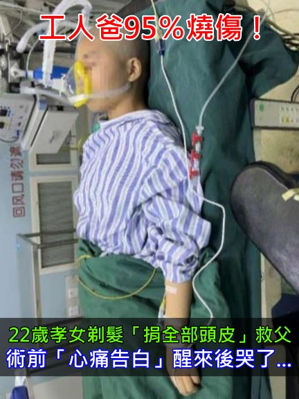 爸爸95％燒傷！22歲女剃髮「捐出全部頭皮」救父　躺病床「心痛發聲」網哽咽：孝女難得