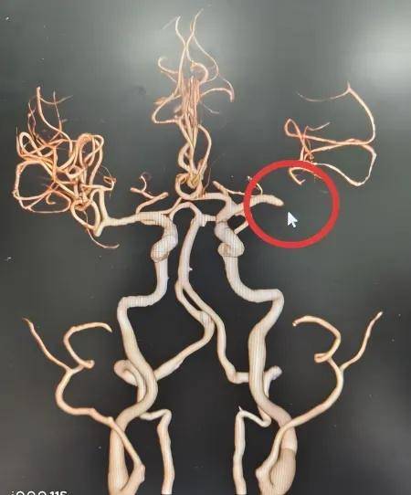 洗澡突發腦梗！85歲阿公「緊急入院」15分鐘活命　「新技術曝光」急性腦梗有救了