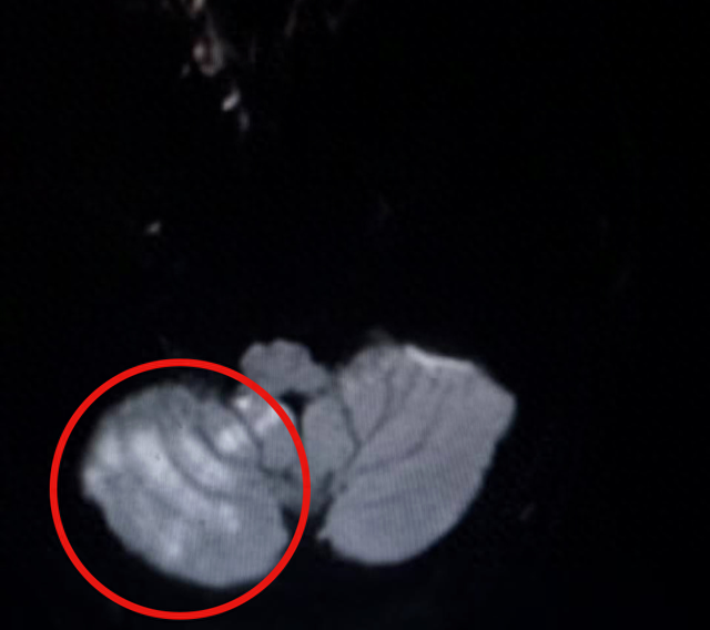 老公太累了！老婆好心「幫做一件事」　竟害47歲夫「小腦梗死」