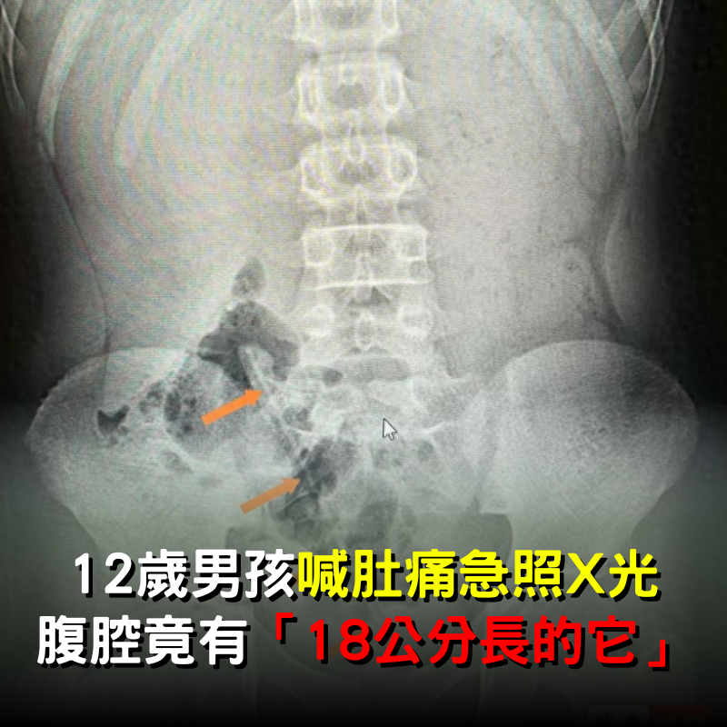 12歲男孩「喊肚痛急照X光」！一看腹腔竟有「18公分長的它」醫生也看傻：怎麼進去的