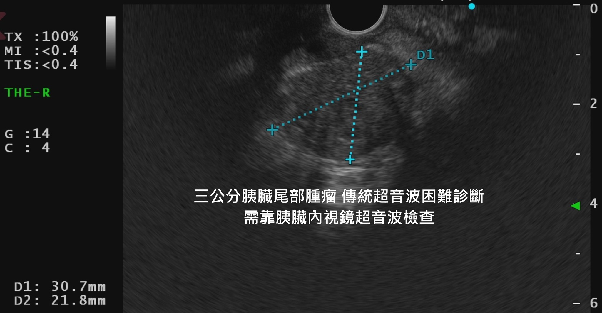 腰痛近4個月！60歲婦「一查罹癌王」醫師嘆：錯過黃金期　曝「三大症狀難察覺」發現已晚期