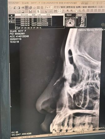 嫁議員尪9年！台語女歌手驚傳「臉部爆血送醫」　認了是他害的「床上血跡斑斑」