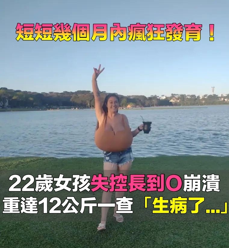 才短短幾個月！她胸部失控瘋長「變成O罩杯」　「走在路上被狂看」醫生一看愣了
