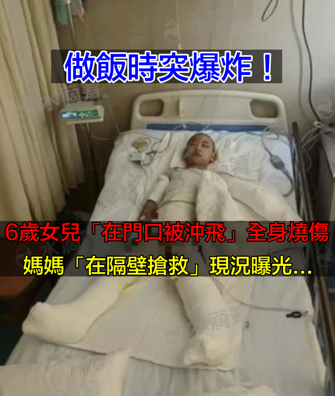 做飯時突爆炸！6歲女兒「在門口被沖飛」全身通紅　「母女嚴重燒傷」現況曝光：仍徘徊鬼門關