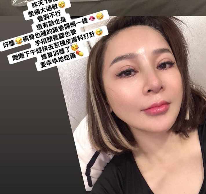 彩樺姐怎麼了？出席活動「包子臉+香腸嘴」網看傻　她「無奈曬檢驗單」：不是整形...
