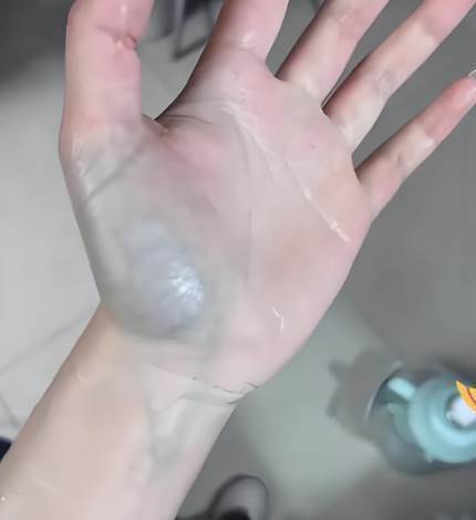 她曬出「手掌瘀青照」納悶問:這顏色正常嗎?網一看「勸快去掛急診」檢查結果讓她腿軟