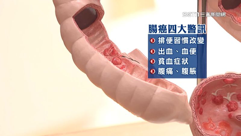 術後惡化到四期！腸癌患者「拒吃青菜」仍有奇蹟　醫生揭關鍵「每天吃半碗它」：2年半未復發